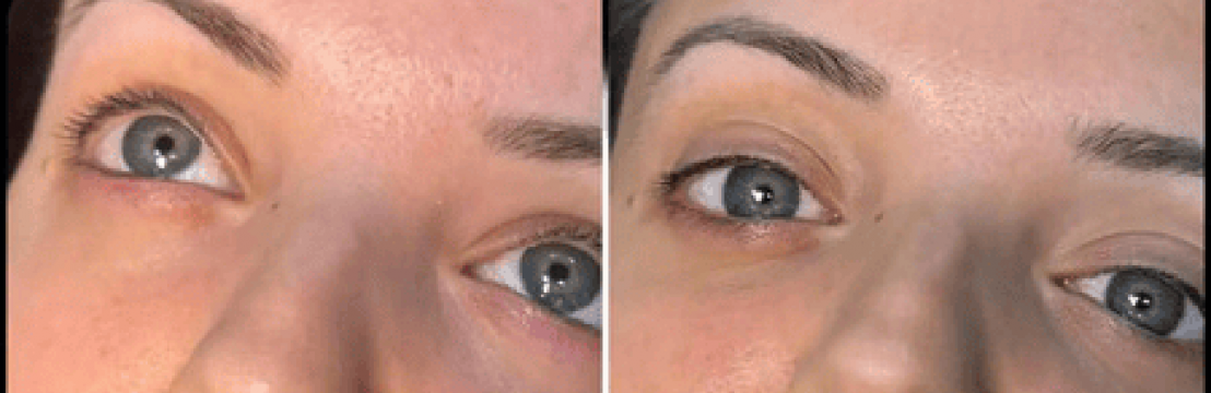 Dermal Fillers